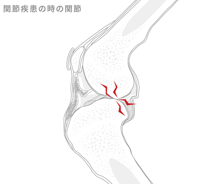 関節疾患の時の関節