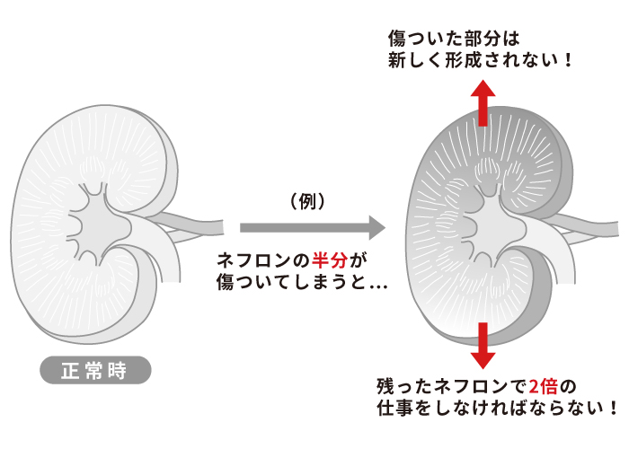 腎臓病（慢性腎臓病・腎疾患）とは？