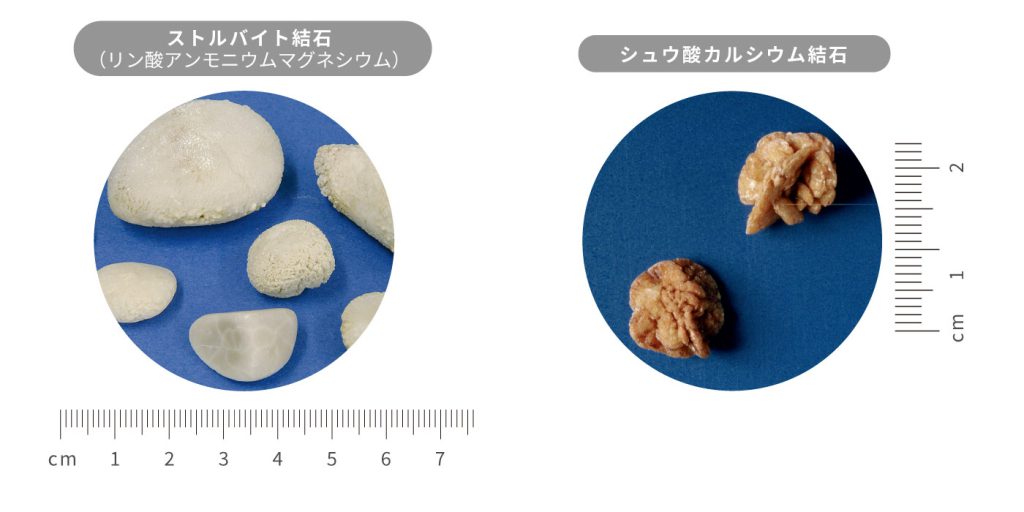 代表的な尿路結石