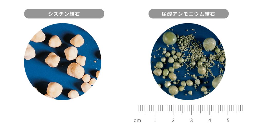 その他の尿路結石